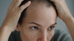 Волосы раздора: супруги развелись после 16 лет брака из-за облысения