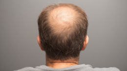 Почему выпадают волосы: врач развеяла популярные заблуждения