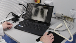 Внимание к рукам: раскрыт «геометричный» признак рака легких