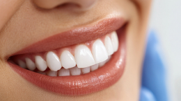 «Хочу результат сейчас»: почему виниры стали популярны среди зумеров