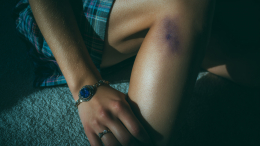 Терапевт назвал причины частого появления синяков на теле