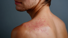 Смешивается с кожным салом: что провоцирует появление прыщей на спине