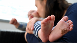 Тревожный сигнал: когда родимое пятно у младенца требует лечения