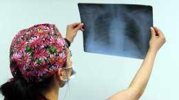 Пальцы меняют форму: назван неочевидный симптом рака легких